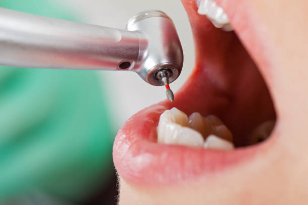 Best Knocked-Out Tooth (Avulsed Tooth) Treatment in Kirkl, IN